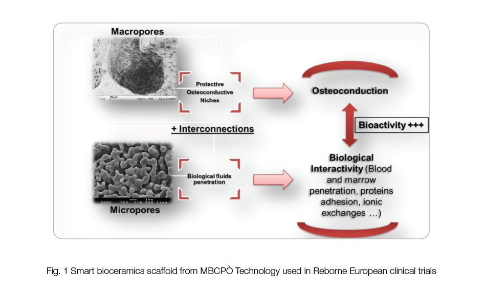 Figure 1: Smart bioceramics scaffold from MBCP&Ograve; Technology used in Reborne European clinical trials